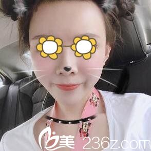 做面部自体脂肪填充面部半个月效果 做面部自体脂肪填充面部半个月效果