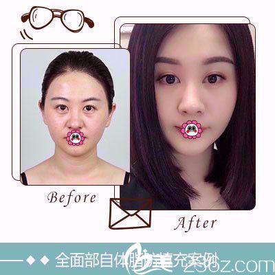 雅芳亚面部填充案例