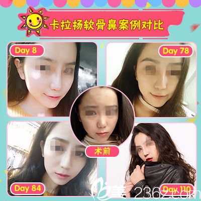 石家庄雅芳亚隆鼻案例