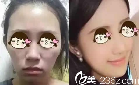 太原华美李晨阳玻尿酸面部填充案例效果图