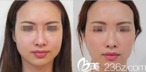 东莞缔美医疗美容陈星光面部注射效果图