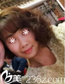 重庆美仑美奂肖倩玻尿酸去法令纹效果 重庆美仑美奂肖倩玻尿酸去法令纹效果