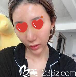 做假体综合隆鼻术后一周拆线