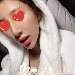 在<!--<i data=20240703-sp></i>-->做假体综合隆鼻术后半个月<span style=