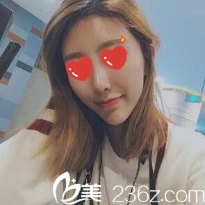 闺蜜看到我在整形医院做的综合假体隆鼻术后1个月恢复效果后说也想去做