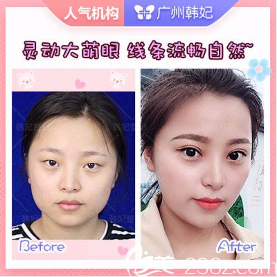 广州韩妃整形医院<!--<i data=20240703-sp></i>-->军做的切开双眼皮案例 广州韩妃整形医院<!--<i data=20240703-sp></i>-->军做的切开双眼皮案例