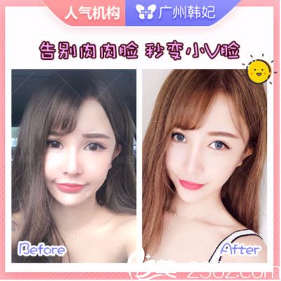 广州韩妃<!--<i data=20240703-sp></i>-->军做的面部吸脂案例 广州韩妃<!--<i data=20240703-sp></i>-->军做的面部吸脂案例