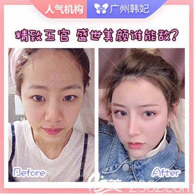 广州韩妃<!--<i data=20240703-sp></i>-->军做的双眼皮隆鼻脂肪填充案例 广州韩妃<!--<i data=20240703-sp></i>-->军做的双眼皮隆鼻脂肪填充案例