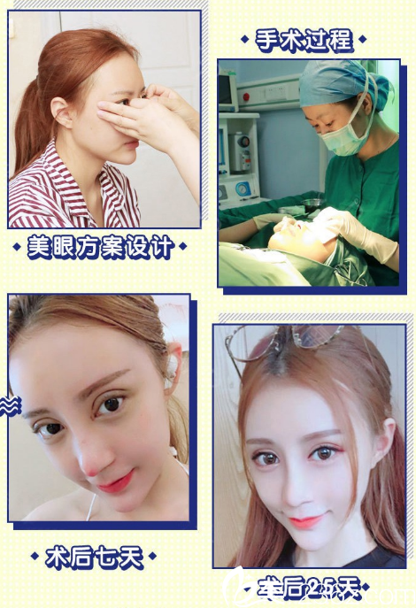 广州韩妃王媛医生割的双眼皮案例图片 广州韩妃王媛医生割的双眼皮案例图片