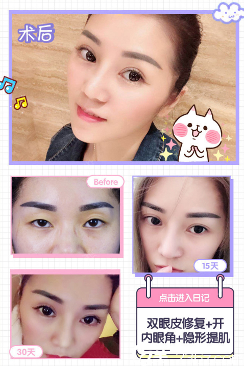广州韩妃王媛医生做的双眼皮失败修复案例过程图片 广州韩妃王媛医生做的双眼皮失败修复案例过程图片
