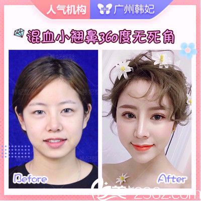 广州韩妃于洪瑞做的鼻综合隆鼻案例图