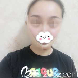 面部吸脂术后天 面部吸脂术后天