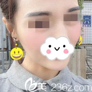 术后第14天 术后第14天