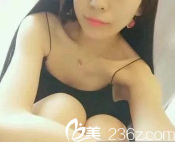 假体隆胸手术前 假体隆胸手术前