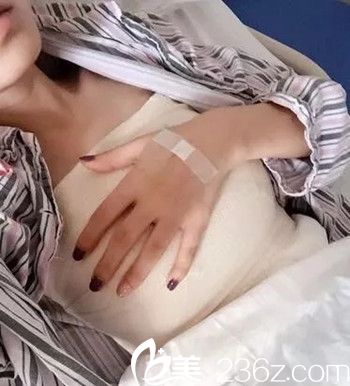 吴伟林医生给我做假体隆胸手术后4天 吴伟林医生给我做假体隆胸手术后4天