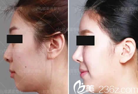 太原欧美莲雷雪华隆鼻效果图