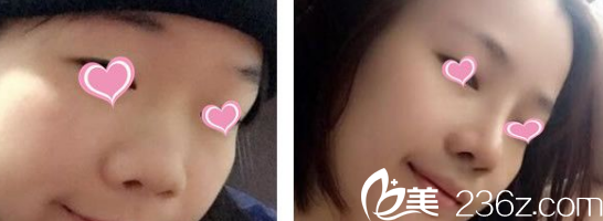 淮北相山时光刘家贺隆鼻综合整形案例 淮北相山时光刘家贺隆鼻综合整形案例