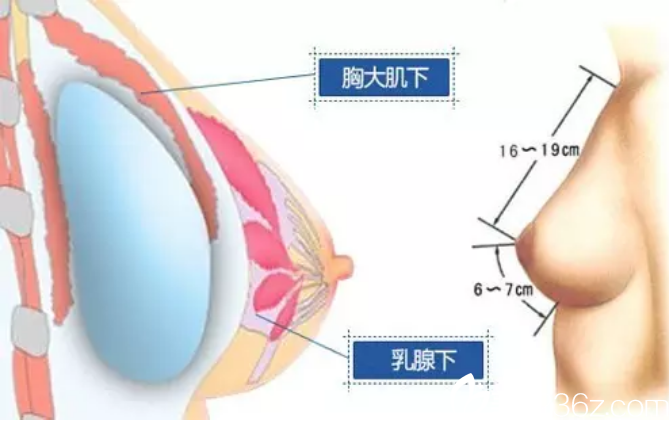 假体隆胸之假体在胸部放置在哪里？