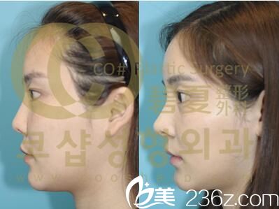 李珉奭院长鼻整形真人前后效果对比