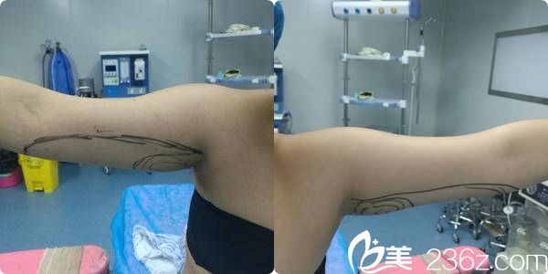 激光溶脂瘦胳膊术前划线设计 激光溶脂瘦胳膊术前划线设计