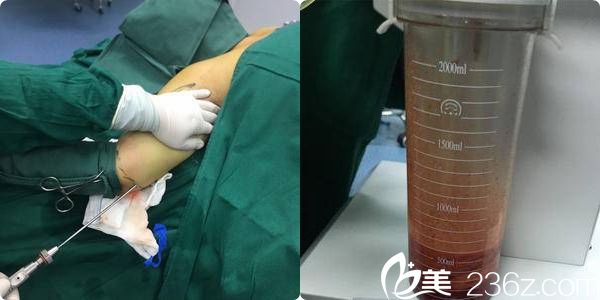 溶脂瘦胳膊手术中 溶脂瘦胳膊手术中