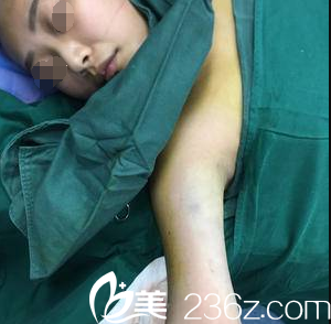 刚做完激光溶脂瘦胳膊 刚做完激光溶脂瘦胳膊