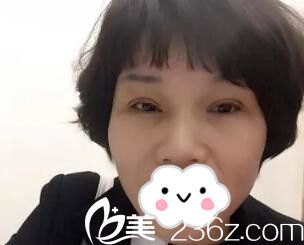 做切开双眼皮术后一周效果