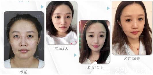 上海首尔丽格医疗美容医院眼综合真人案例