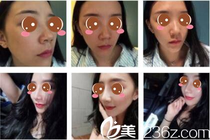 上海薇琳医疗美容医院假体隆鼻真人案例