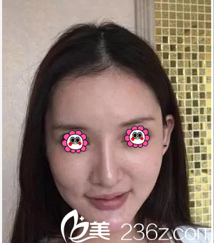 在北京米兰柏羽丽都做埋线提升前样子 在北京米兰柏羽丽都做埋线提升前样子