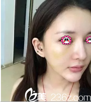 丽都石冰给我做埋线提升第3天效果 丽都石冰给我做埋线提升第3天效果