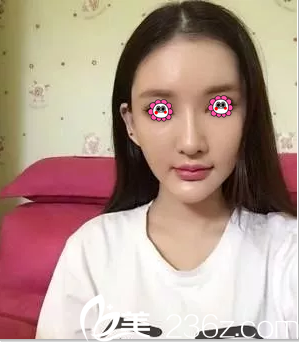 在北京米兰柏羽丽都做埋线提升第27天样子 在北京米兰柏羽丽都做埋线提升第27天样子