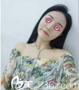 北京米兰柏羽丽都面部埋线提升案例 北京米兰柏羽丽都面部埋线提升案例