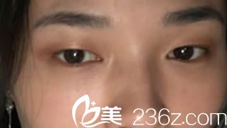 我去韩国清潭整形外科做双眼皮前照片 我去韩国清潭整形外科做双眼皮前照片