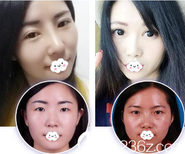 淮北时光双眼皮真人案例效果对比图