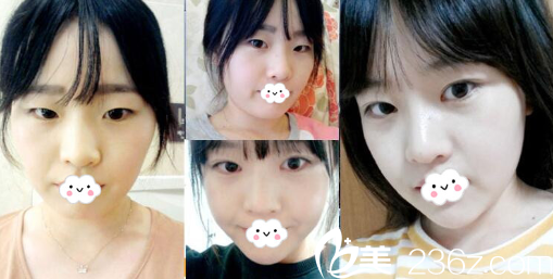 淮北割双眼皮哪家好？淮北时光案例对比