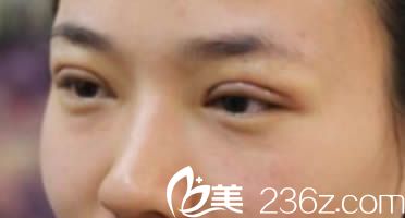 我在韩国清潭做双眼皮天照片 我在韩国清潭做双眼皮天照片