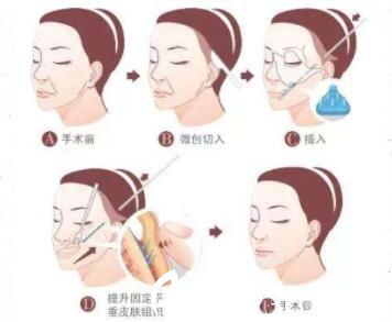 面部线雕手术方法