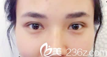 韩国清潭切开双眼皮术后10天图 韩国清潭切开双眼皮术后10天图