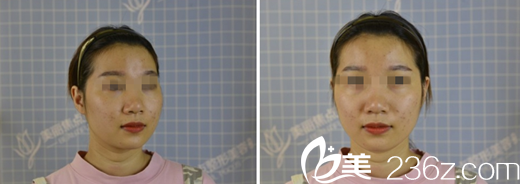 在桂林美丽焦点做激光美肤前 在桂林美丽焦点做激光美肤前