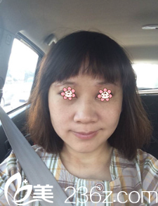 朱晓东面部埋线提升术后半个月