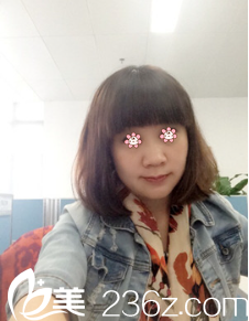 贵阳美贝尔埋线提升术后一个月