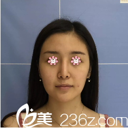 术前我的皮肤有点下垂 术前我的皮肤有点下垂