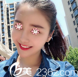 何林面部线雕提升术后10天 何林面部线雕提升术后10天