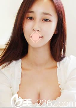 韩国博朗温做假体隆鼻+假体隆胸三个月后的照片