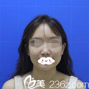 隆鼻失败的我 隆鼻失败的我