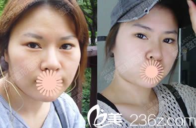 韩国ITEM爱婷整形医院术前照 韩国ITEM爱婷整形医院术前照