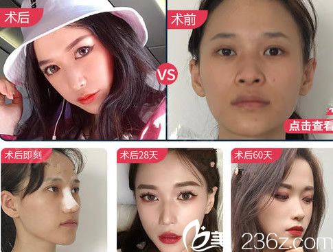 穆威鼻综合案例及其恢复过程图展示 穆威鼻综合案例及其恢复过程图展示