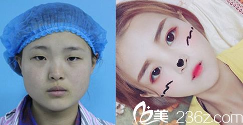 台美丽格院长叶凡眼综合整形案例 台美丽格院长叶凡眼综合整形案例