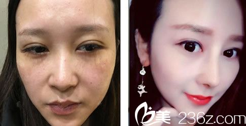 叶凡耳软骨复合隆鼻案例 叶凡耳软骨复合隆鼻案例